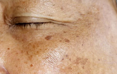 你不知道的祛斑消痘印小竅門(mén)，方便又省錢(qián)