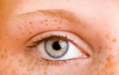 女人黃褐斑是怎么形成的？主要與這幾大因素有關(guān)