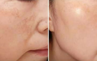 都說祛斑難，對不起，那是他因為你沒選對方法！